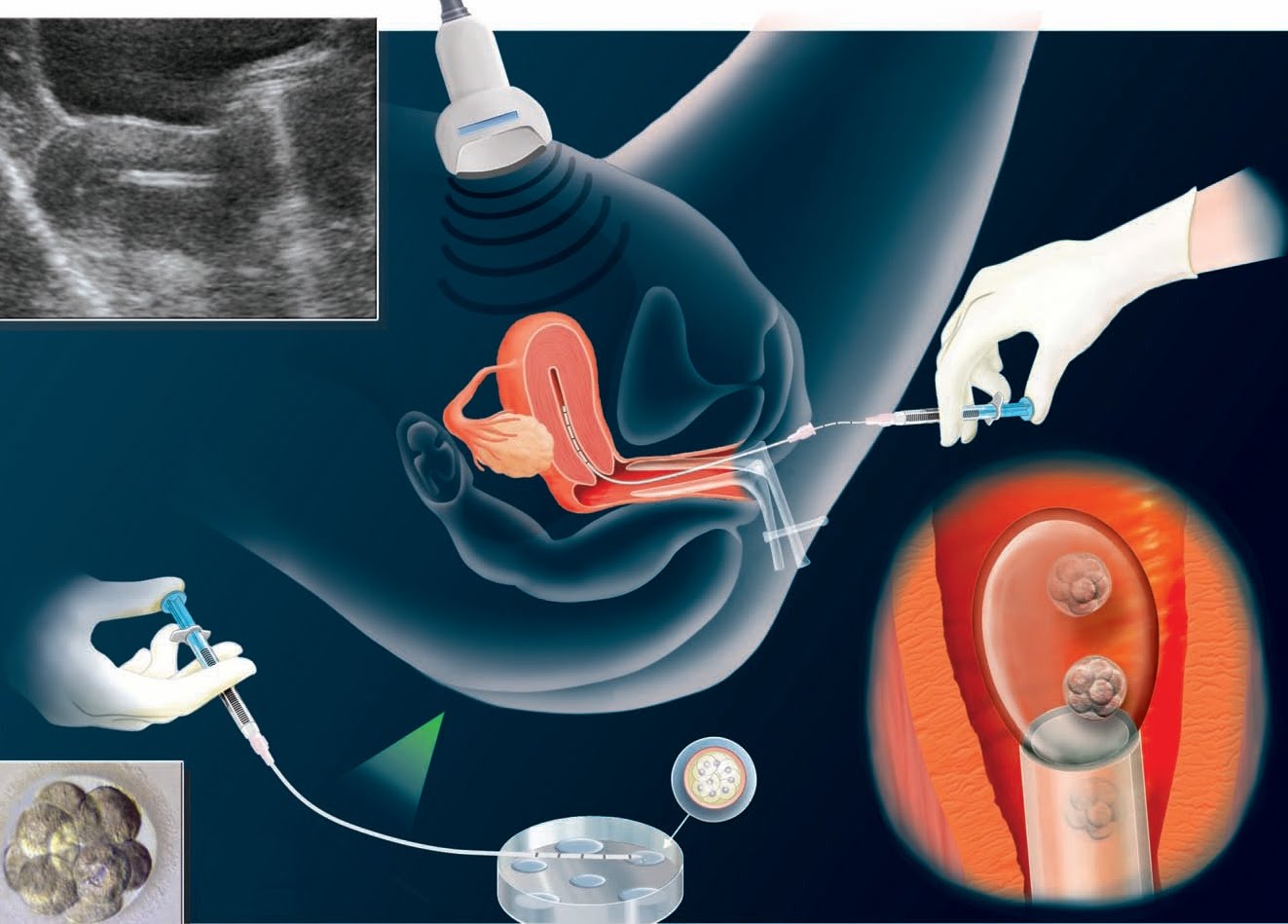 IVF Treatment