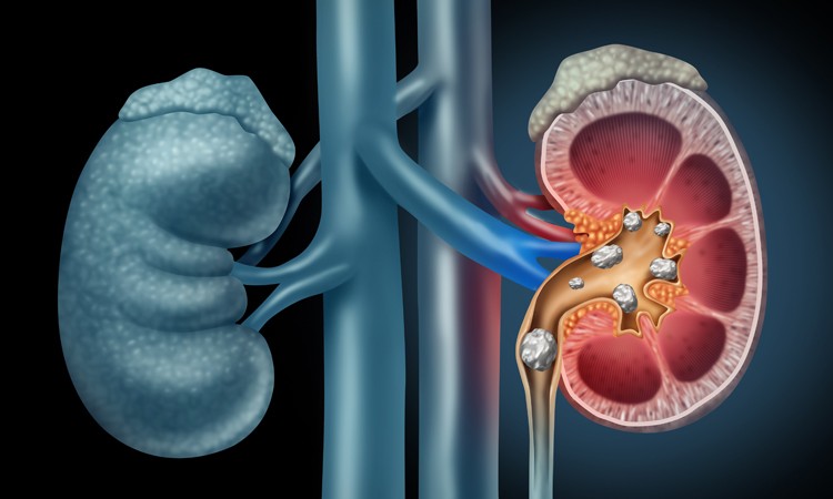 Kidney Stone Surgery And Treatments