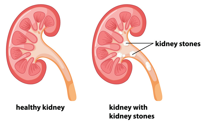 Kidney Stone Surgery in Kurnool