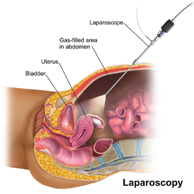 Laparoscopic Urology Treatment
