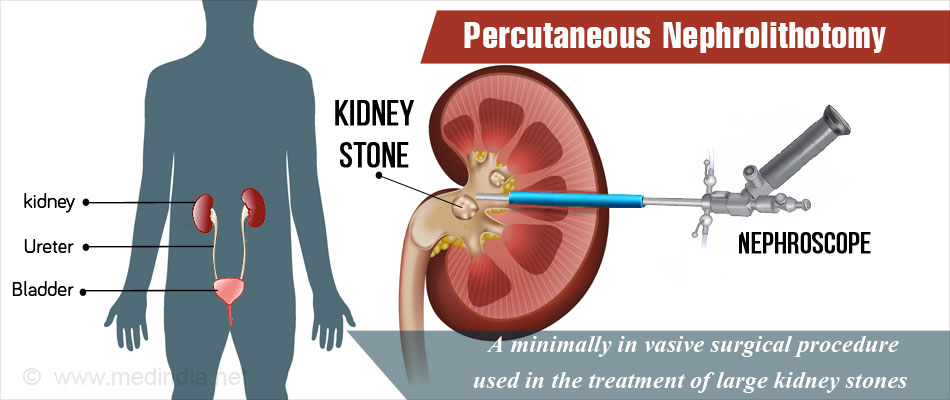 Percutaneous Nephrolithotomy (PCNL) Surgery In Kurnool