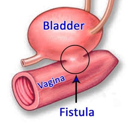 Vesicovaginal fistula (VVF) Surgery